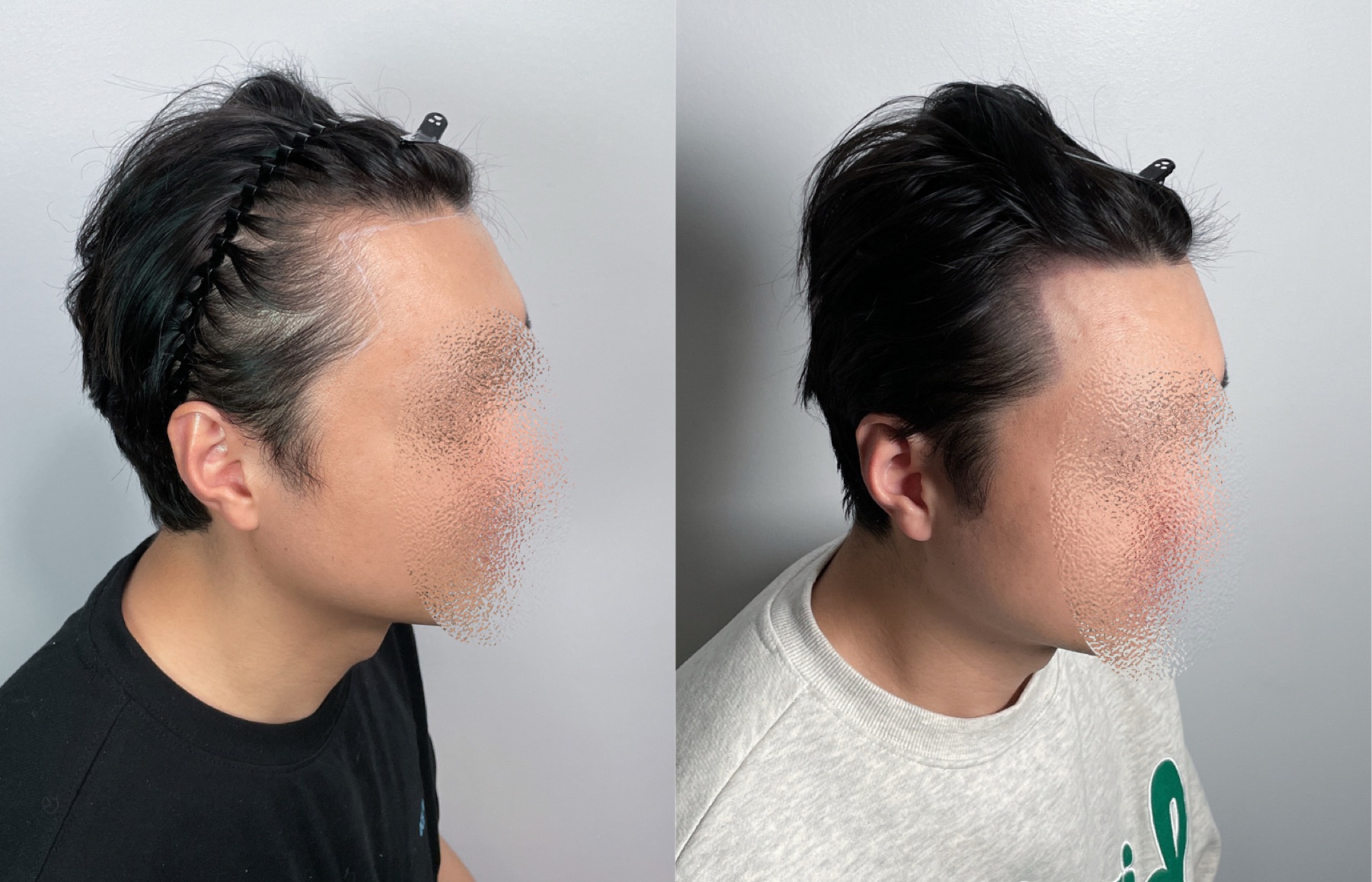 Hairline SMP portfolio 1