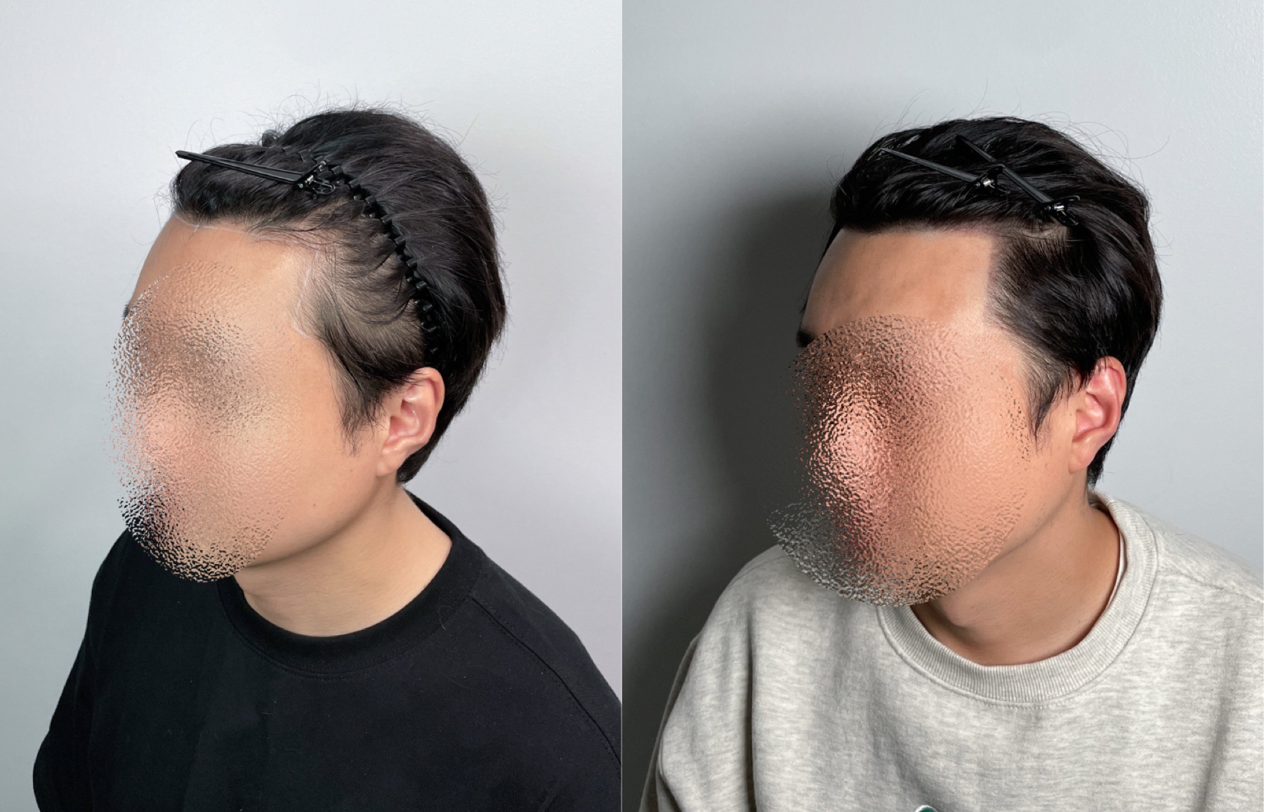 Hairline SMP portfolio 2