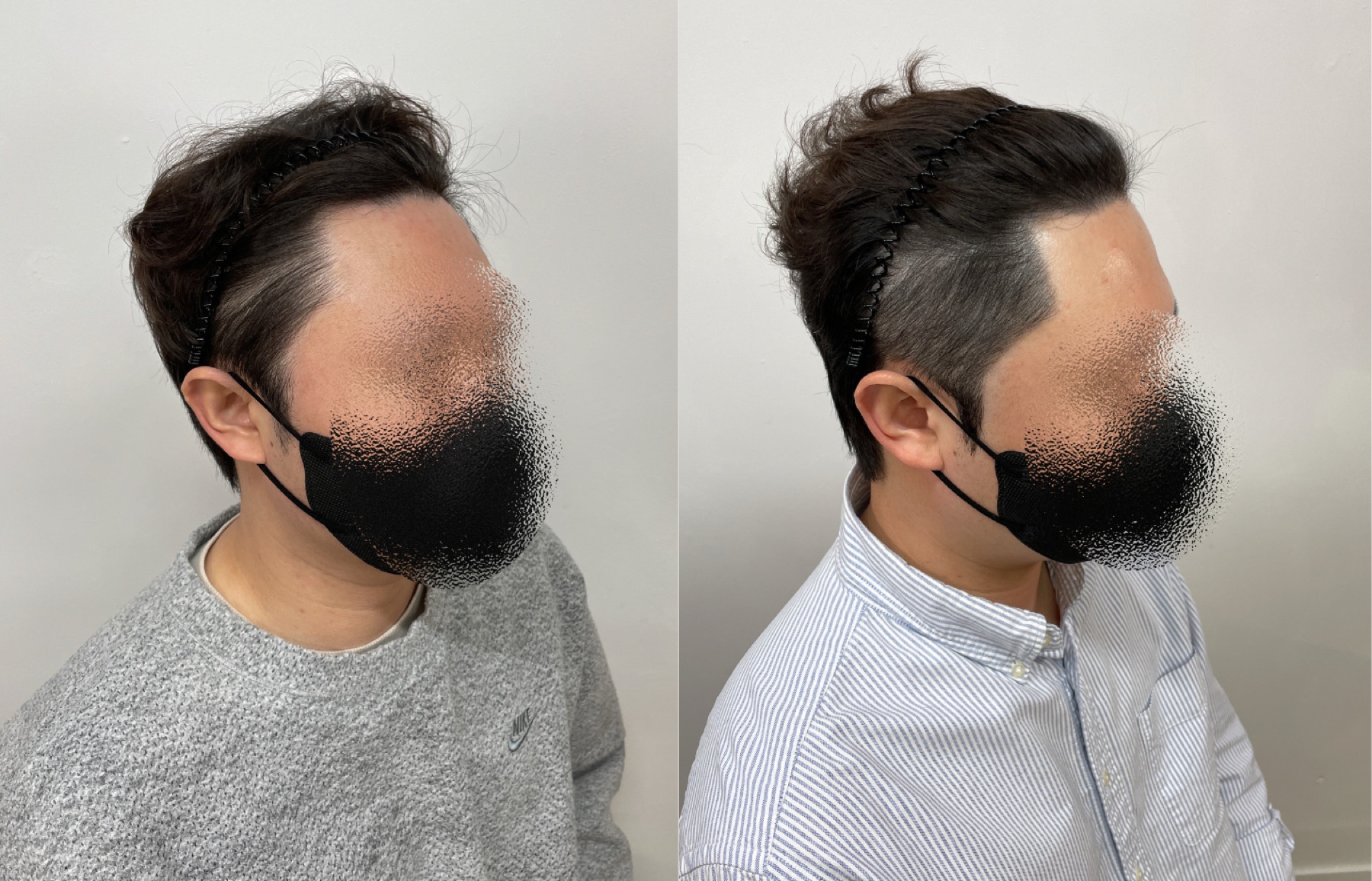Hairline SMP portfolio 3