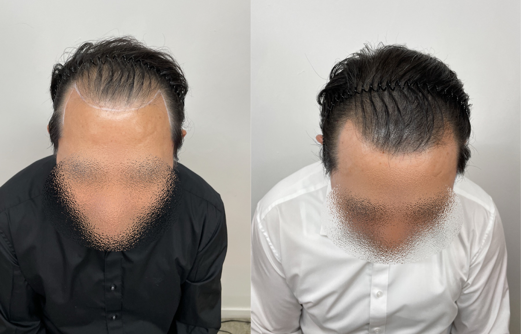 Hairline SMP portfolio 4