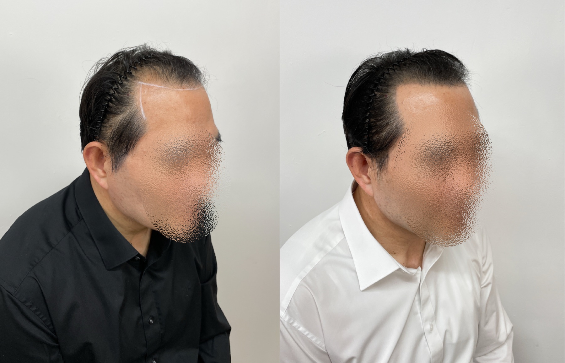 Hairline SMP portfolio 5