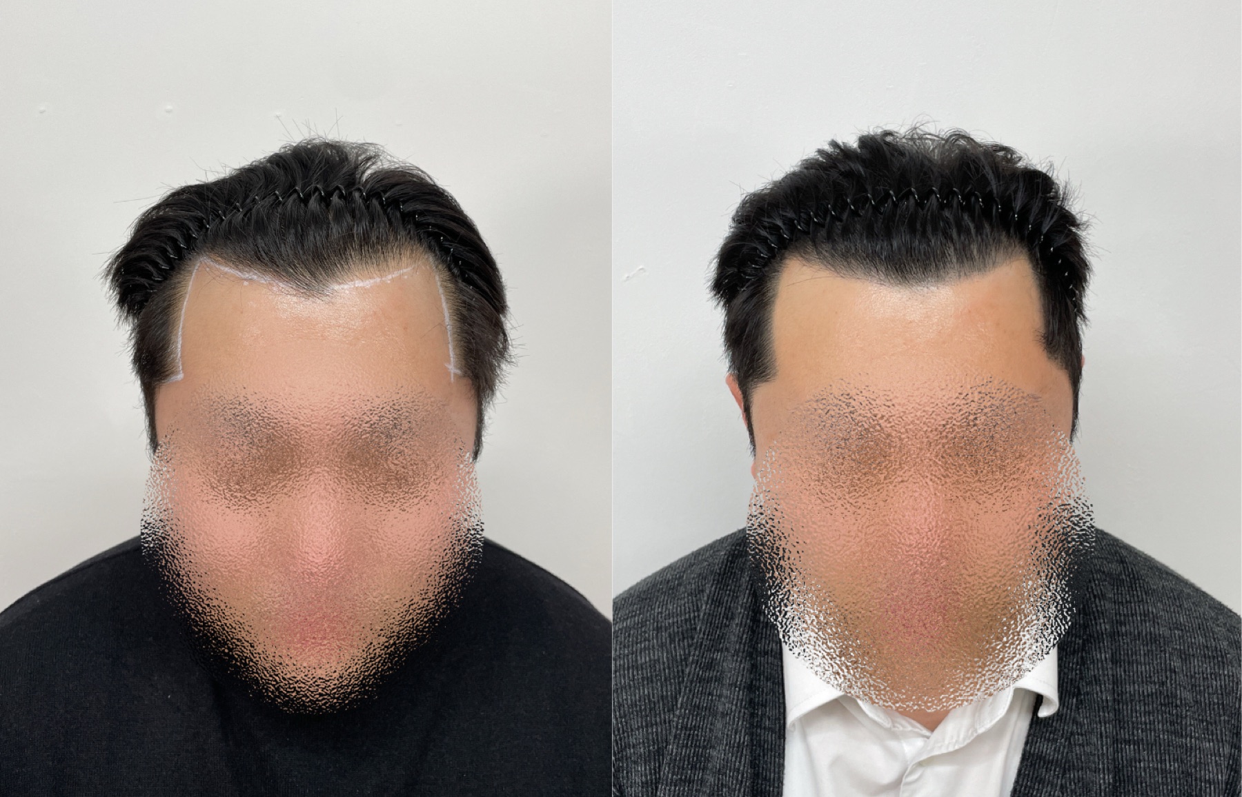 Hairline SMP portfolio 6