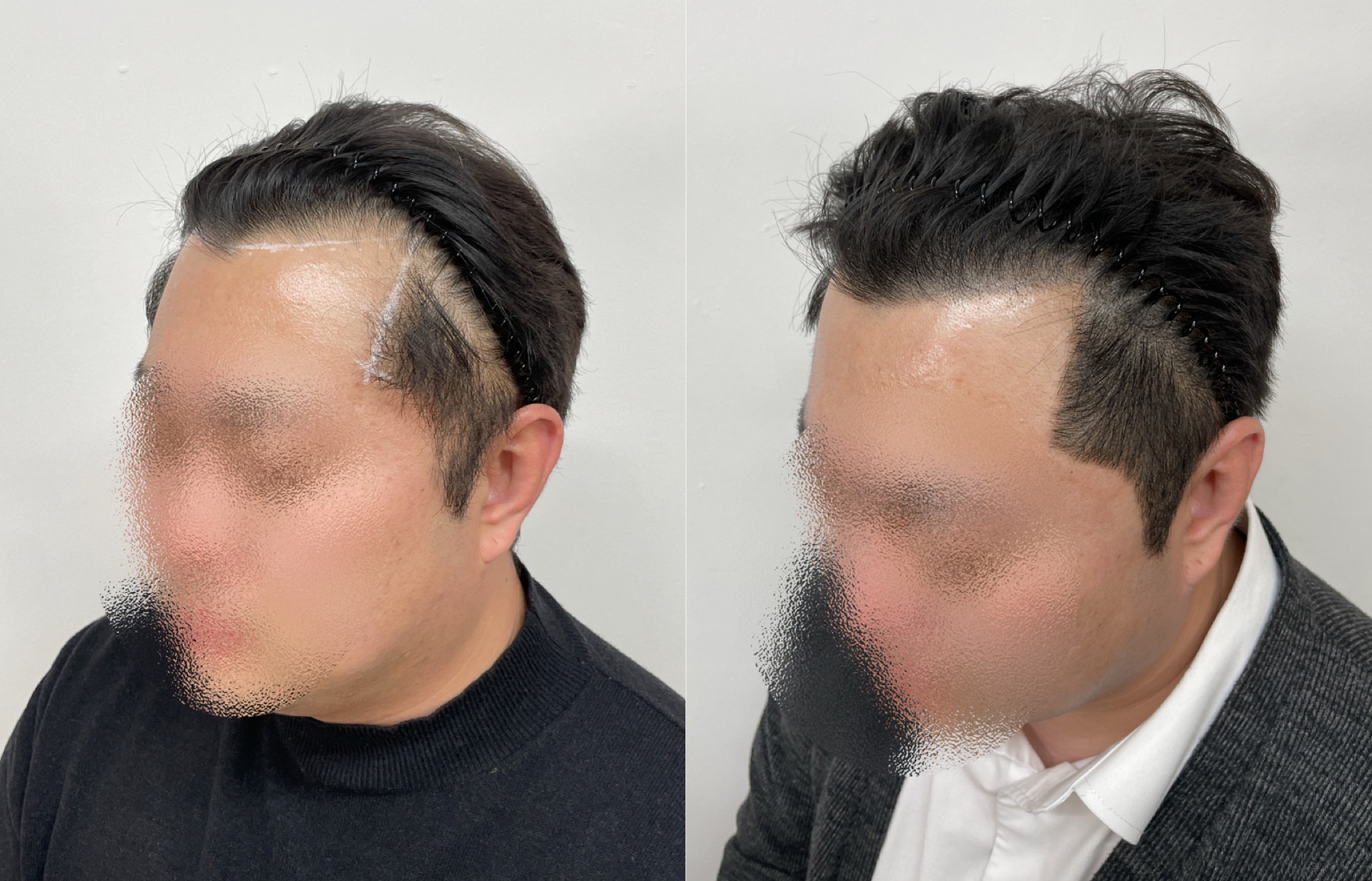 Hairline SMP portfolio 7
