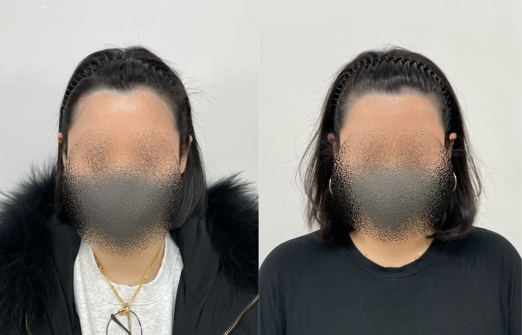 Hairline SMP portfolio 8