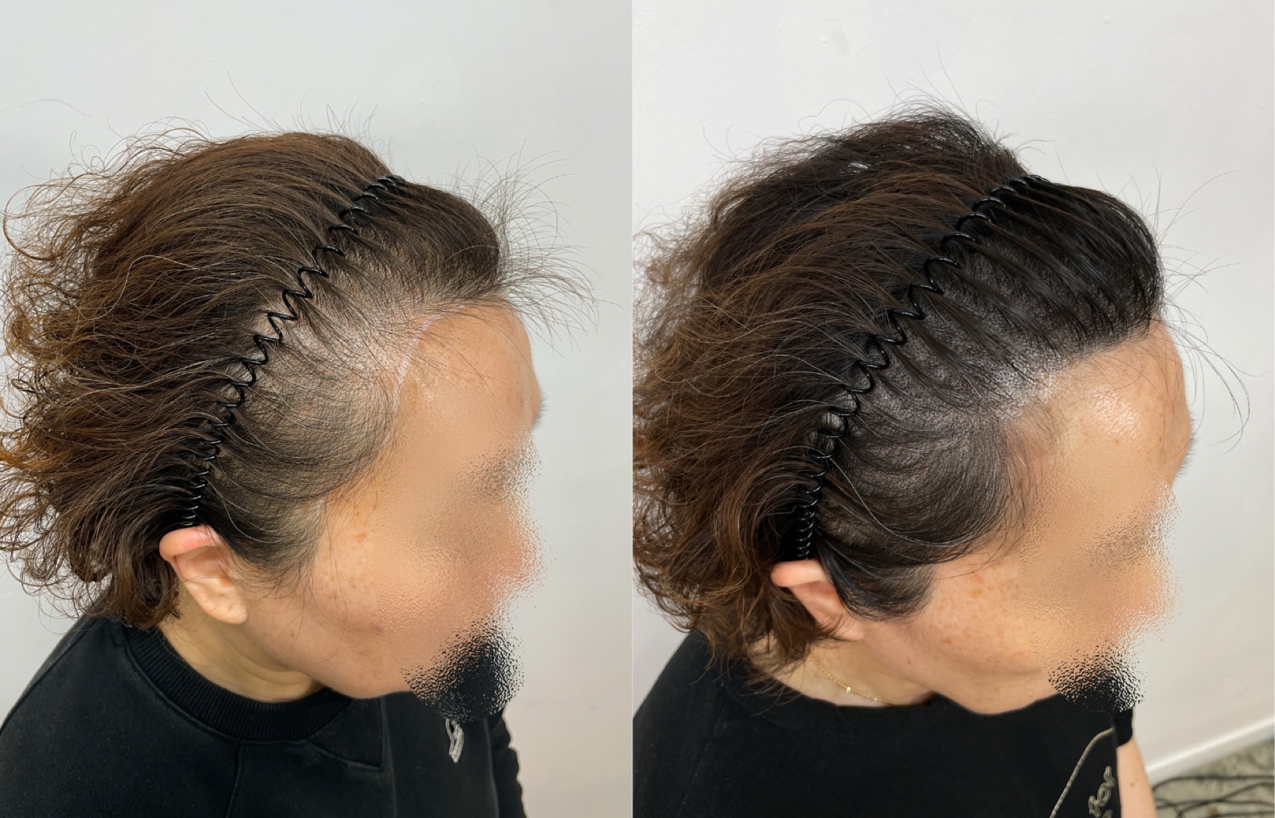 Hairline SMP portfolio 11