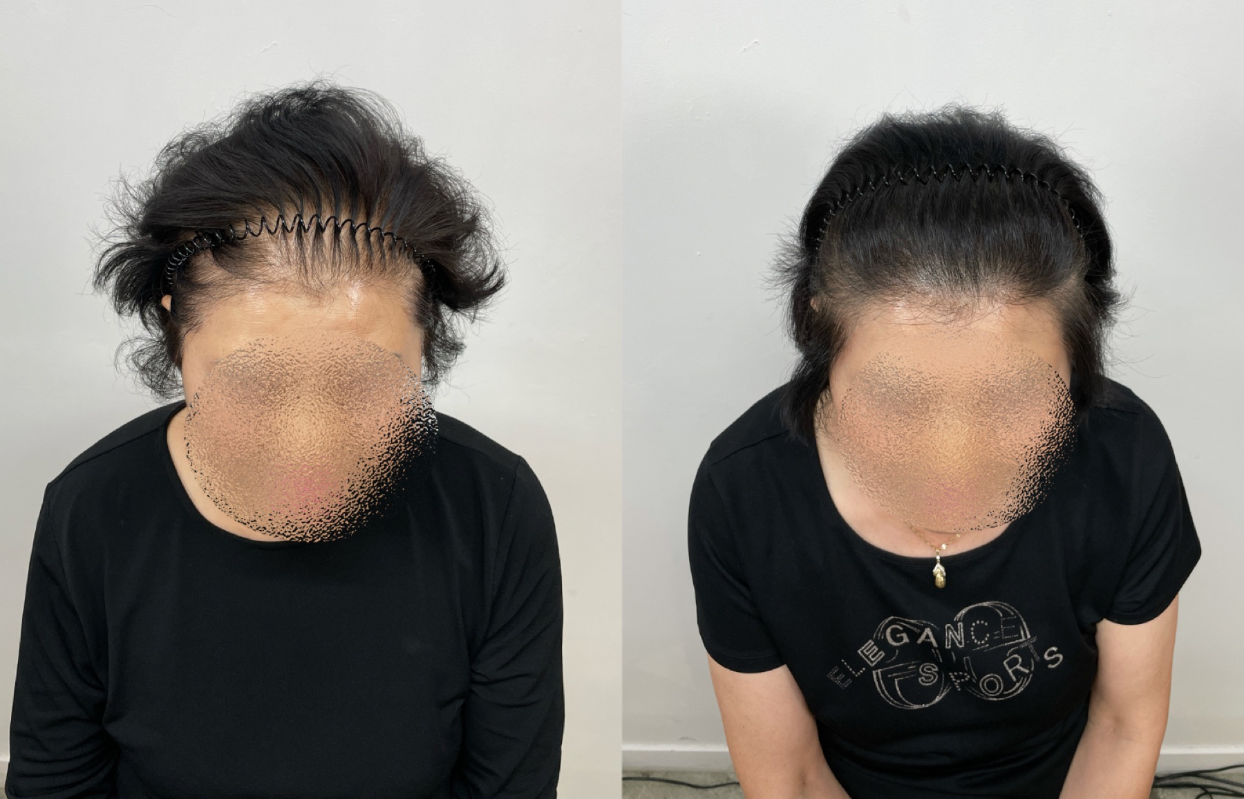 Hairline SMP portfolio 12