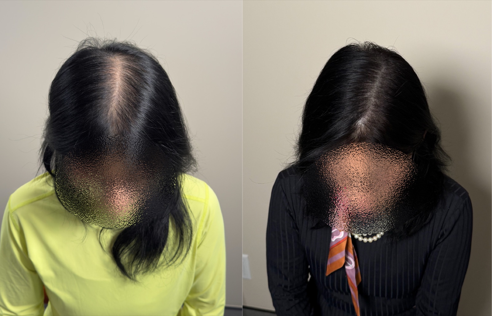 Hairline SMP portfolio 12